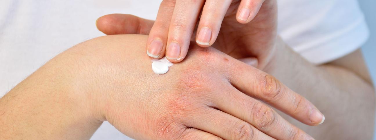 Trattamento della dermatite atopica: come si cura?