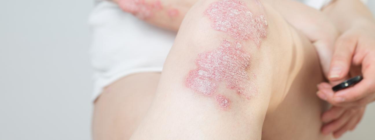 Più consapevoli sulla Psoriasi