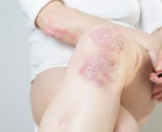 Più consapevoli sulla Psoriasi