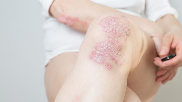 Più consapevoli sulla Psoriasi