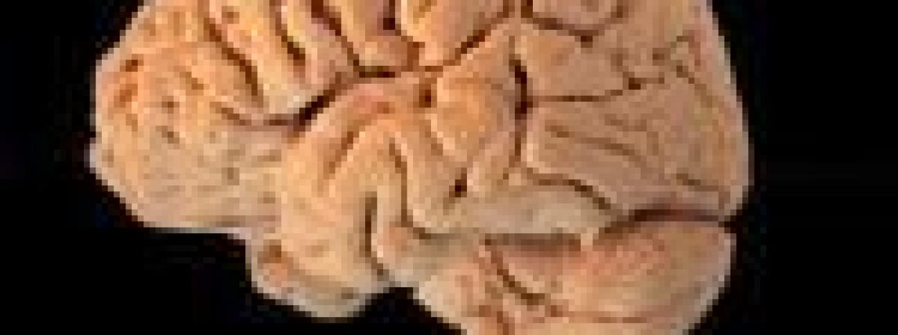 Neurologiche più della metà delle malattie rare