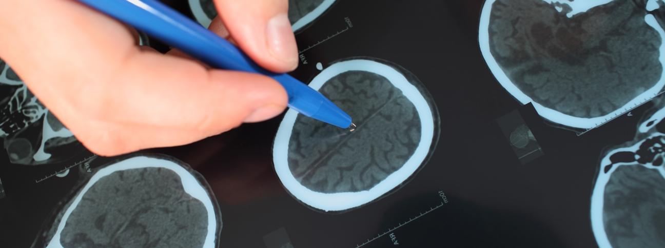 Svolta nella lotta ai tumori del cervello