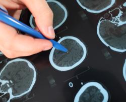 Svolta nella lotta ai tumori del cervello