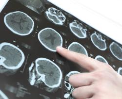 29 ottobre 2009: V edizione della Giornata contro l'ictus cerebrale