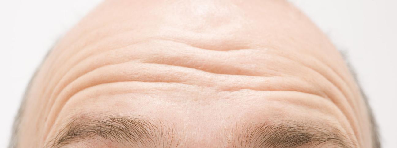 Alopecia: una cura contro lo stress potrebbe combatterla