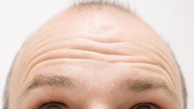 alopecia una cura contro lo stress potrebbe combatterla