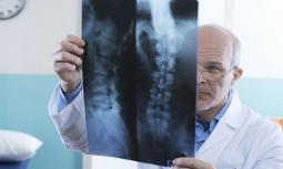 Fratture vertebrali: come trattarle