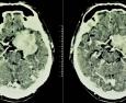 I problemi cognitivi al centro della Settimana mondiale del cervello
