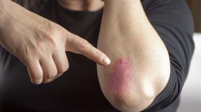 I disturbi della sfera emotiva e la psoriasi sarebbero legati a doppio filo. lo stress puo causare la psoriasi