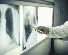 Tumore al polmone: prima terapia orale alternativa alla chemioterapia 