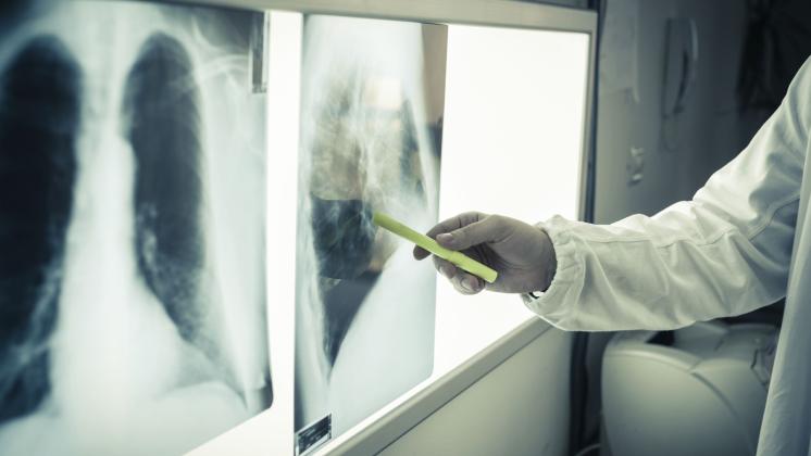 Tumore al polmone: prima terapia orale alternativa alla chemioterapia 